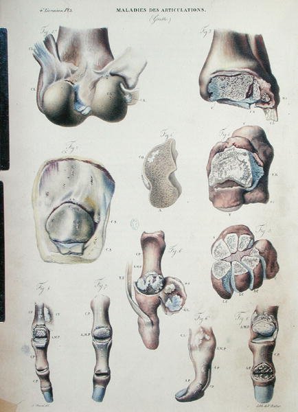 जीन क्रूविलियर (1791-1874) 1828-42 (रंगीन उत्कीर्णन) द्वारा 'मानव शरीर के पैथोलॉजिकल एनाटॉमी' से जोड़ों के रोग द्वारा एंटोनी चज़ल