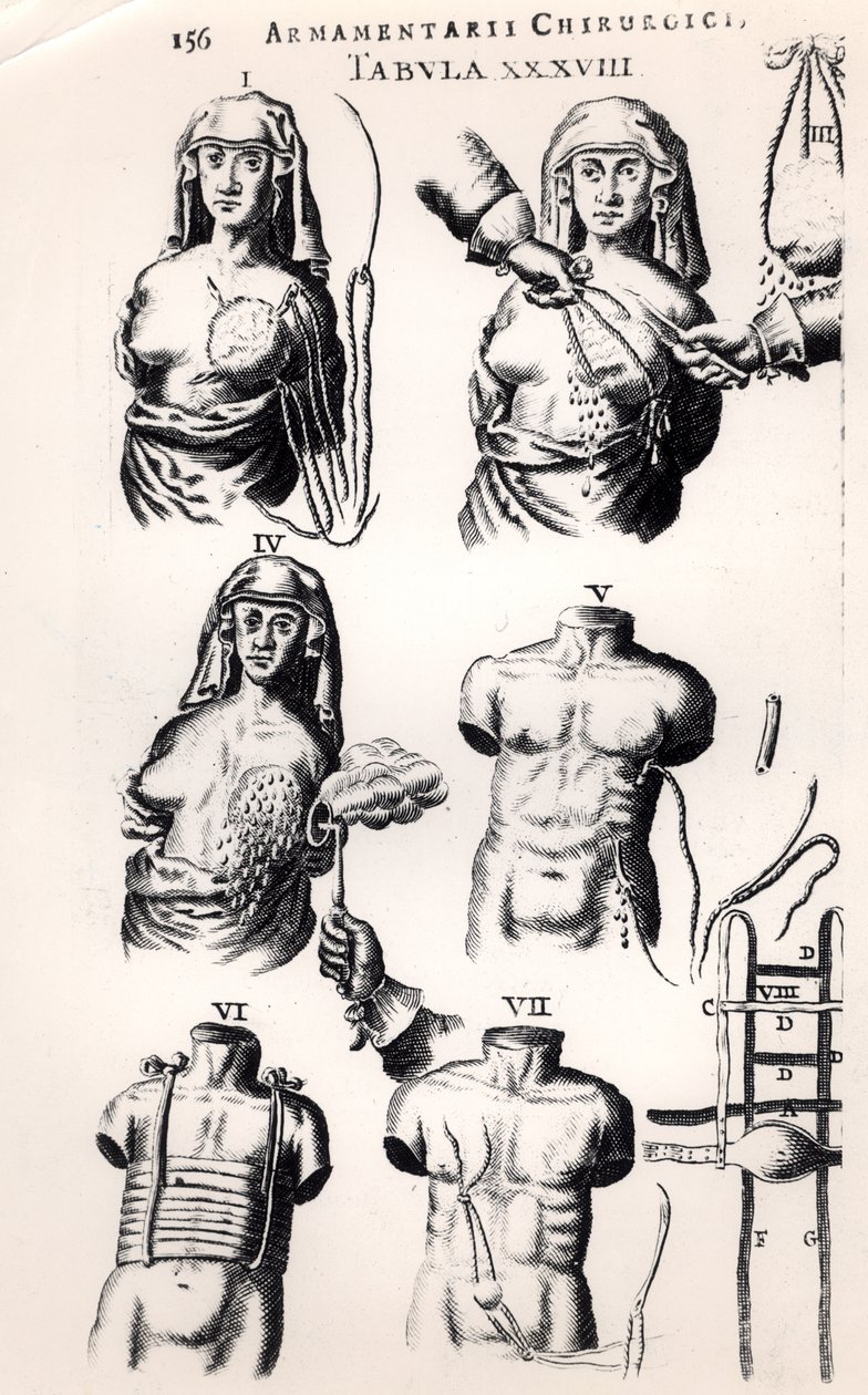 स्तन कैंसर पर संचालन, जोहानस शुल्टेस (1595-1645) द्वारा आर्मामेंटरी चिरुर्गिकी से, एम्स्टर्डम में 1672 में प्रकाशित द्वारा डच स्कूल