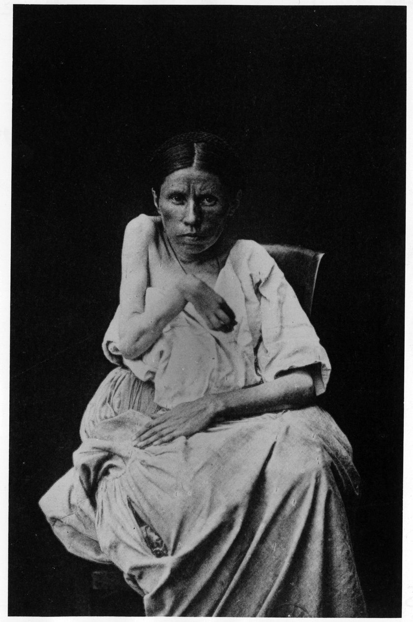 हेमिप्लेजिक मिर्गी से पीड़ित एक मरीज की तस्वीर, -इन "" सालपेट्रिएर, बॉर्नविले और पी। रेग्नार्ड, पेरिस की फोटोग्राफिक आइकनोग्राफी द्वारा फ्रेंच फोटोग्राफर