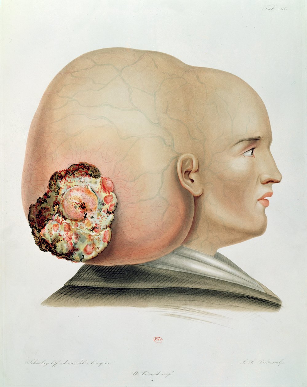 ड्यूरा मेटर का कवक, अलेक्जेंडर औवर्ट, पेरिस, 1856 द्वारा Selecta Praxis Medico-Chirurgica द्वारा फ्रेंच स्कूल