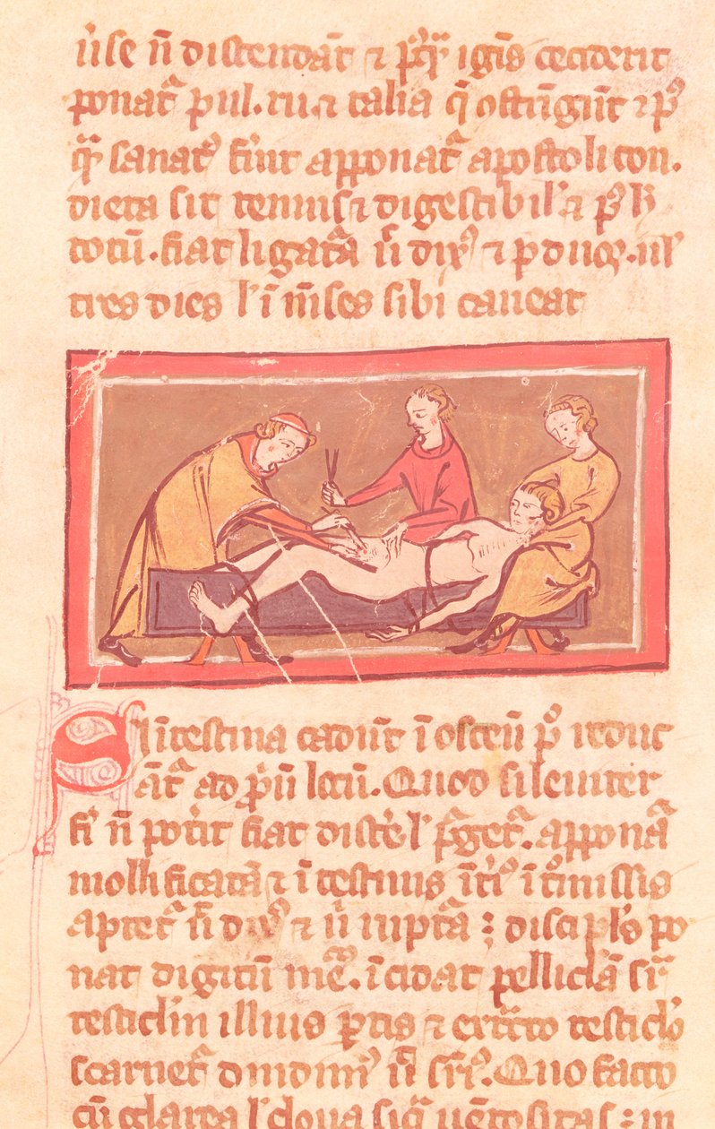 Ms H 89 fol.23 सर्जरी, रोजियर डी सालर्न द्वारा सर्जरी की पुस्तक के एक संस्करण से द्वारा फ्रेंच स्कूल