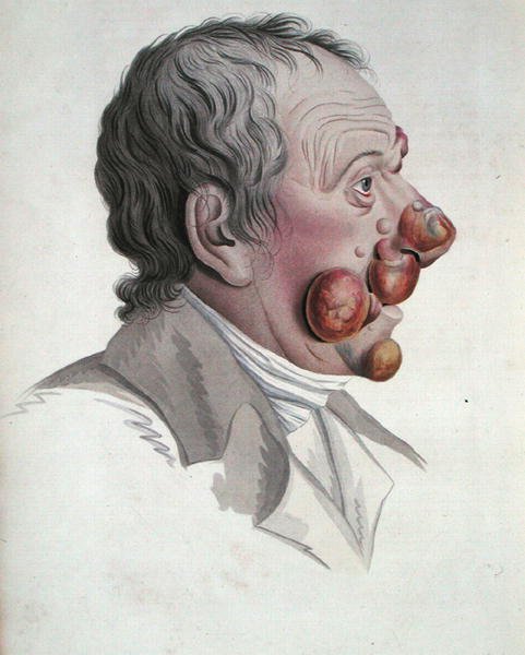 माइकोसिस फोंगोइड, बैरन जीन लुइस एलिबर्ट (1768-1837) 1838 (रंगीन उत्कीर्णन) की एक पुस्तक से द्वारा फ्रेंच स्कूल
