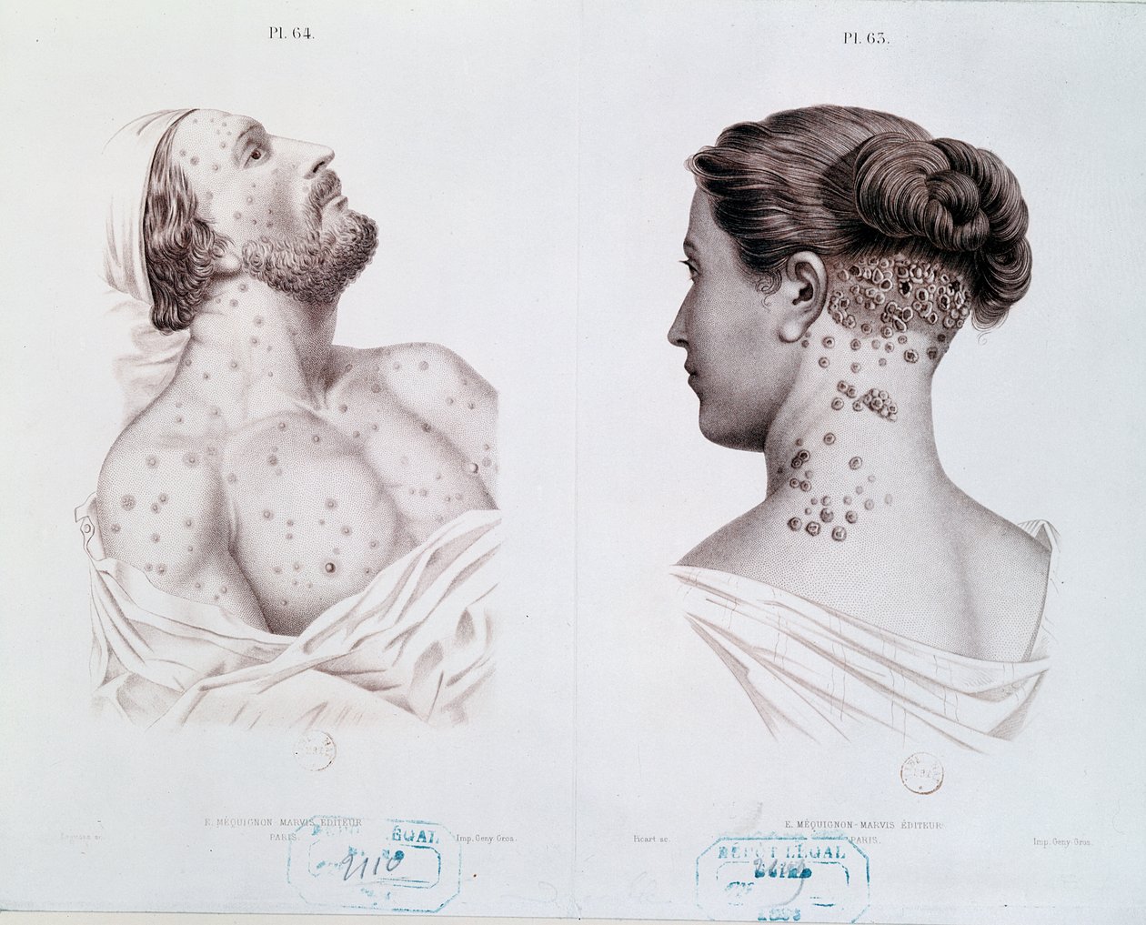 एक चिकित्सा पुस्तक, c.1850-60 से पुरुषों और महिलाओं में उपदंश के लक्षण द्वारा फ्रेंच स्कूल