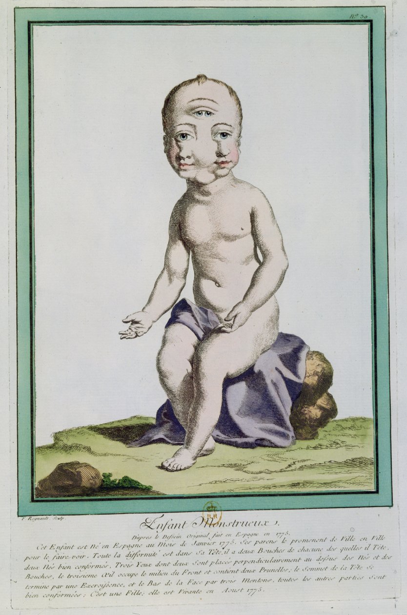 पेरिस, 1775 के &39;लेस इकार्ट्स डी ला नेचर&39; से एक विकृत सिर वाला बच्चा द्वारा जिनेविव रेग्नॉल्ट डी नंगिस