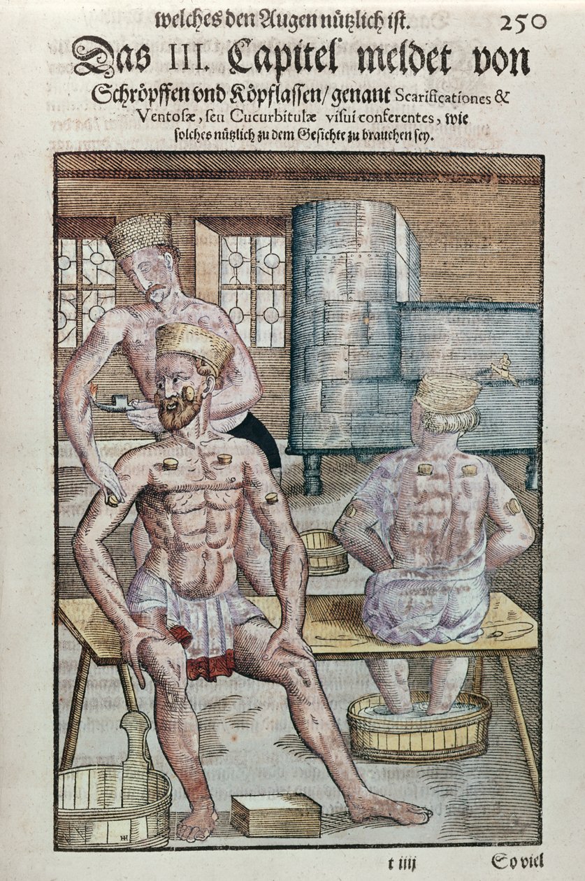 1583 में ड्रेसडेन में कलरफुल (कलर वुडब्लॉक प्रिंट) में प्रकाशित जॉर्ज बार्टिस्क (1535-1636) द्वारा ओफ्थाल्मोडौलिया से क्यूपिंग द्वारा जर्मन स्कूल