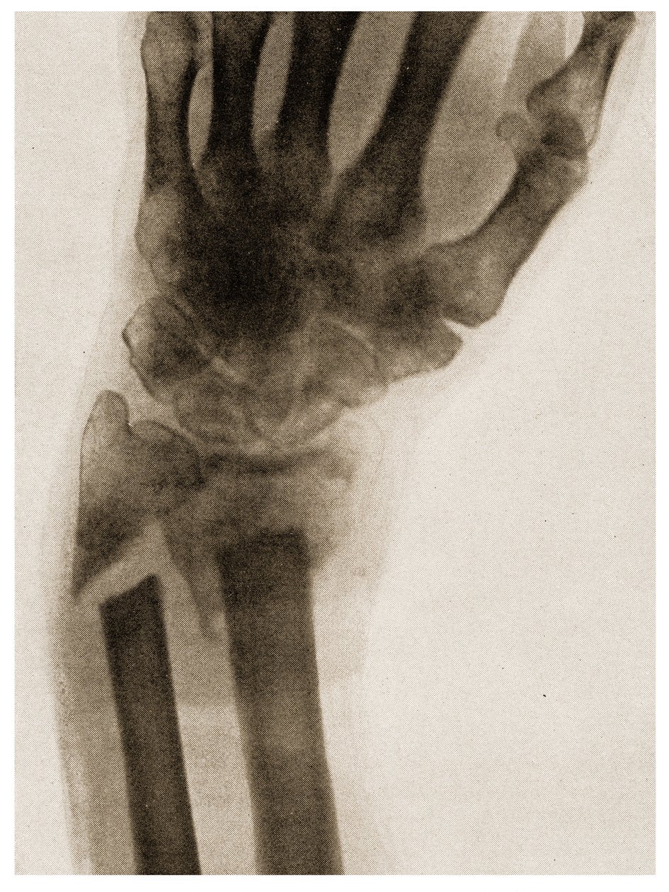 खंडित कलाई का एक्स रे c.1890 द्वारा जर्मन स्कूल