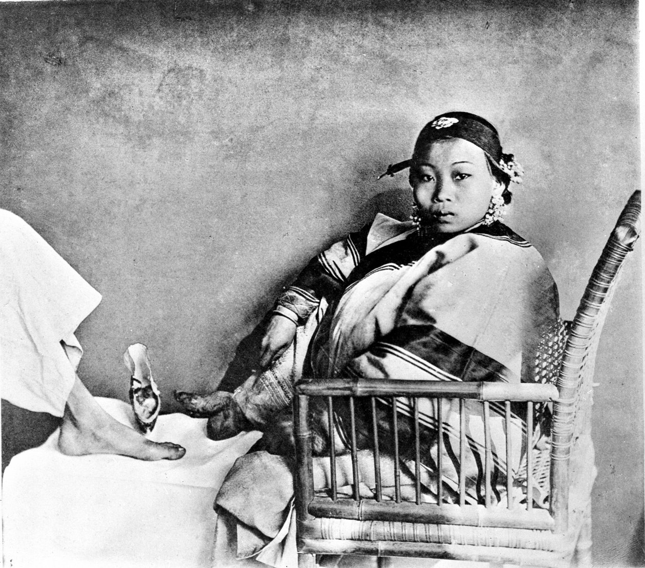 एक यूरोपीय पैर के बगल में पारंपरिक जूते पहनकर अपना पैर क्षत-विक्षत दिखाती महिला (फोटो) द्वारा जॉन थॉमसन