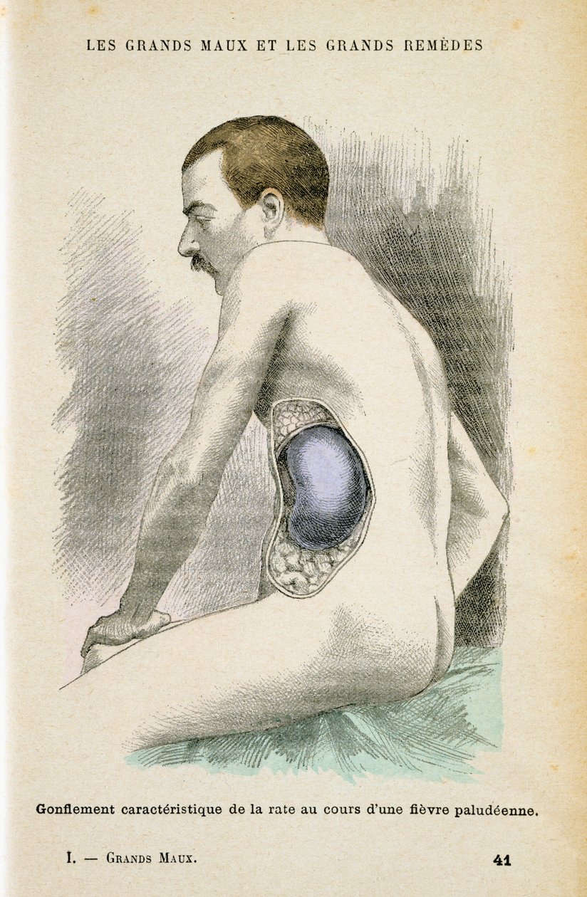 मलेरिया रोगी की विशिष्ट बढ़ी हुई तिल्ली, c1890 द्वारा अज्ञात