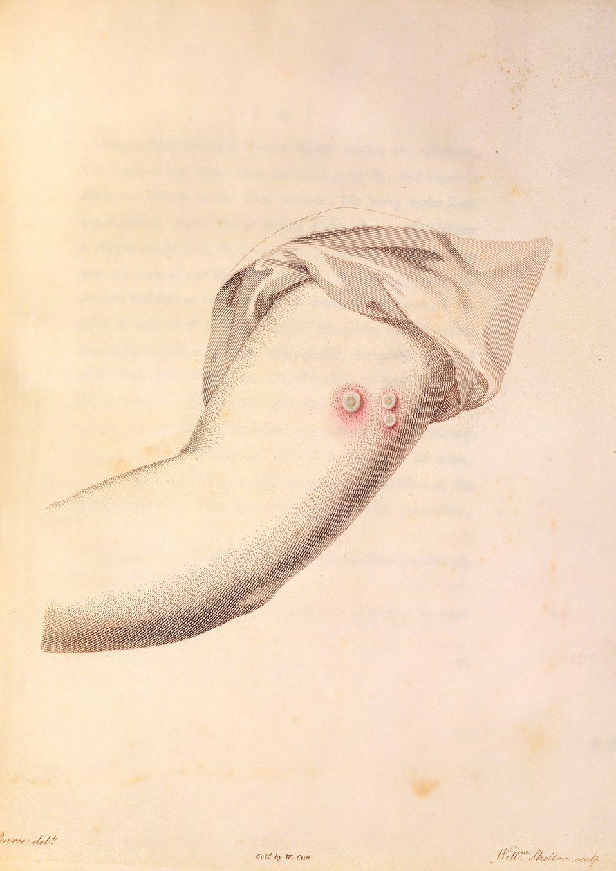 एडवर्ड जेनर (1748-1823) द्वारा पीयर्स, C.1800 द्वारा उत्कीर्ण Inquiry एन इंक्वायरी इन द कॉरिज़ एंड द वेरियॉली वैक्सीन ’से चेचक के टीके के लिए इस्तेमाल किए गए विलियम पेड द्वारा विलियम स्केल्टन