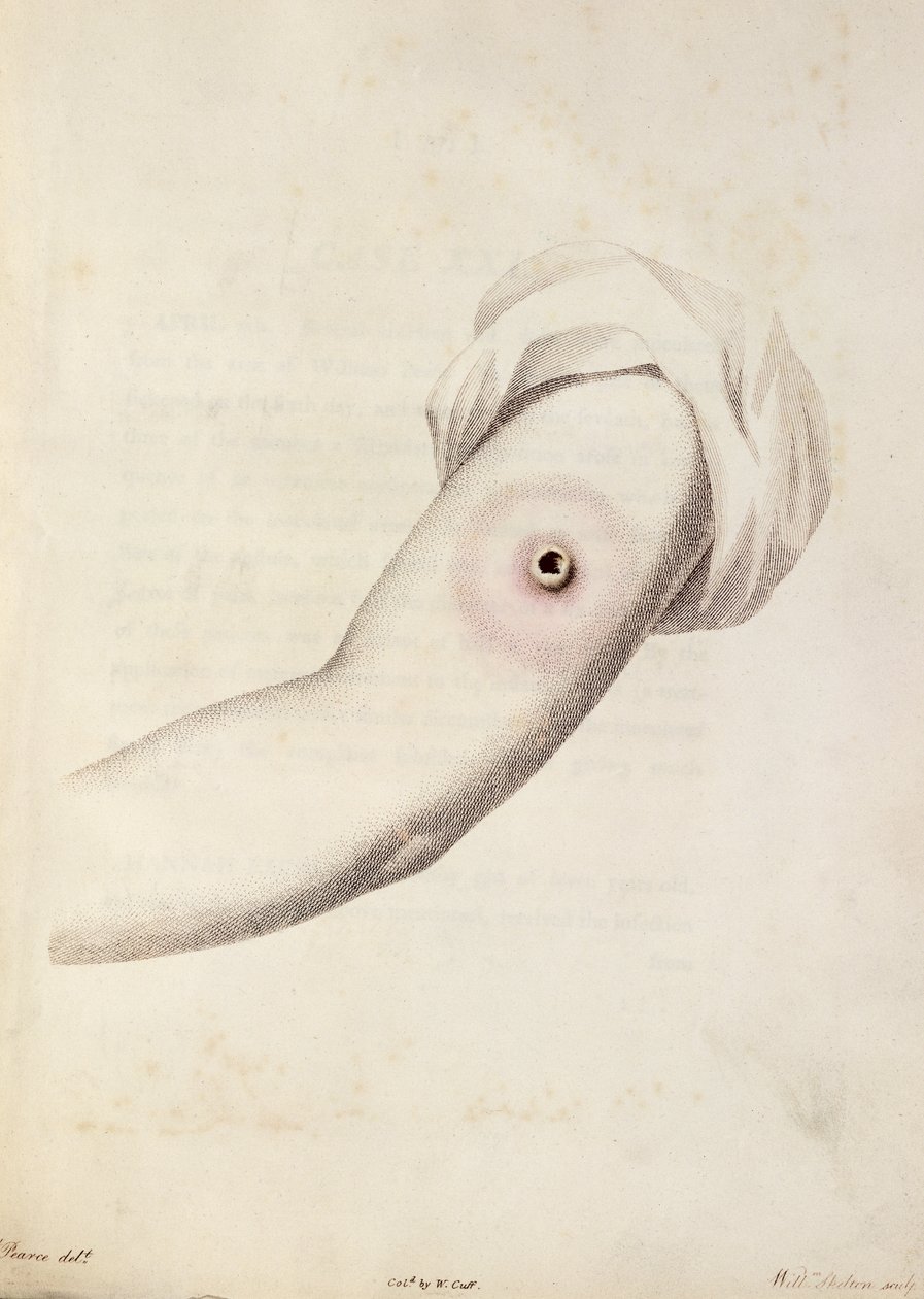 एडवर्ड जेनर (1749-1823) द्वारा पियरस, c.1800 द्वारा उकेरी गई &39;एन इंक्वायरी इन द कॉरीज़ एंड इफेक्ट्स ऑफ़ द वैरियोली वैक्सीन&39; से एक बांह पर चेचक के गुच्छे द्वारा विलियम स्केल्टन