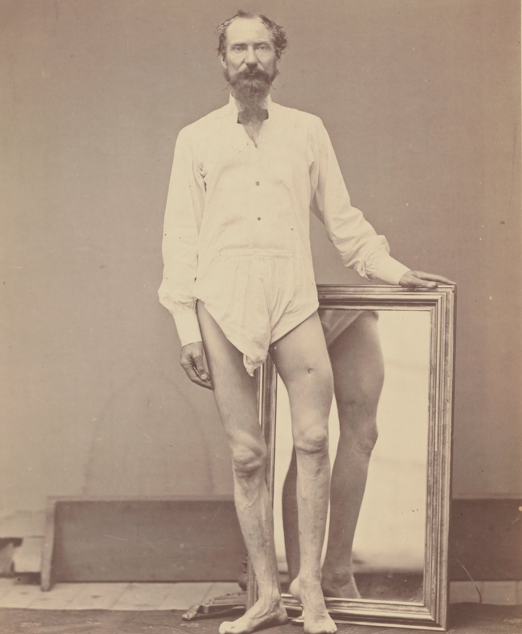 लेफ्ट फीमर के मिडिल थर्ड का गनशॉट वाउंड, 1865-67। द्वारा विलियम एच। बेल