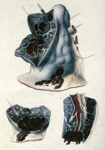 जीन क्रूविलियर (1791-1874) 1828-42 (रंगीन उत्कीर्णन) द्वारा 'मानव शरीर के पैथोलॉजिकल एनाटॉमी' से फेफड़ों के रोग द्वारा एंटोनी चज़ल