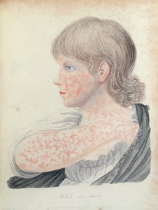 जर्मन खसरा, रॉबर्ट विलेन (1757-1812), 1808 (रंग उत्कीर्णन) द्वारा एक पुस्तक के लिए चित्रण द्वारा अंग्रेजी स्कूल