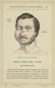 प्रोग्रेसिव फेशियल एरिज़िपेलस (कलर लिथो) द्वारा फ्रेंच स्कूल