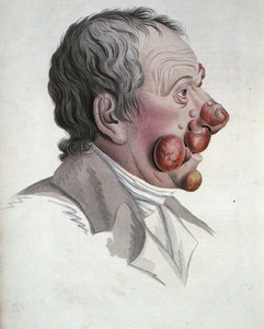 माइकोसिस फोंगोइड, बैरन जीन लुइस एलिबर्ट (1768-1837) 1838 (रंगीन उत्कीर्णन) की एक पुस्तक से द्वारा फ्रेंच स्कूल