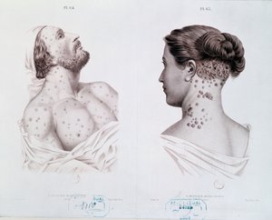 एक चिकित्सा पुस्तक, c.1850-60 से पुरुषों और महिलाओं में उपदंश के लक्षण द्वारा फ्रेंच स्कूल
