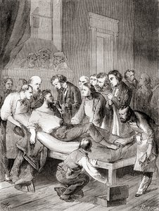 1846 में एक अमेरिकी दंत चिकित्सक, विलियम थॉमस ग्रीन मॉर्टन द्वारा शल्य संवेदनाहारी के रूप में साँस के ईथर के उपयोग का पहला सार्वजनिक प्रदर्शन, 'लेस मर्वेल्स डे ला साइंस' से प्रकाशित, c.1870 द्वारा फ्रेंच स्कूल