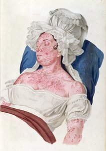 चौपर्ड, 1833 द्वारा उत्कीर्ण बैरन जीन लुइस एलिबर्ट (1768-1837) की एक पुस्तक से स्कारलेट फीवर वाली महिला द्वारा फ्रेंच स्कूल