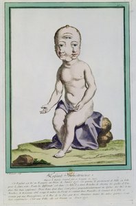 पेरिस, 1775 के &39;लेस इकार्ट्स डी ला नेचर&39; से एक विकृत सिर वाला बच्चा