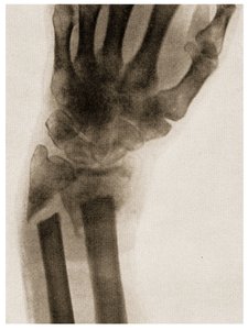 खंडित कलाई का एक्स रे c.1890 द्वारा जर्मन स्कूल