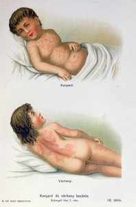 खसरा और स्कार्लेट ज्वर, एक पारिवारिक चिकित्सा पुस्तक से, c.1900 द्वारा हंगेरियन स्कूल
