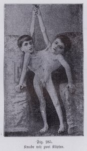 Giacomo और Giovanni Battista Tocci, इतालवी संयुक्त जुड़वां (b/w फोटो)