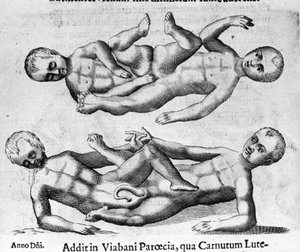 विभिन्न प्रकार के मानव राक्षस: श्रोणि से जुड़े स्याम देश के बच्चे। इटली के वैज्ञानिक फ़ोर्टुनियो लिसेती (1577-1656) द्वारा "डी मॉन्स्ट्रोरम नेचुरा, कॉसिस एट डिफरेंशियल" से उत्कीर्णन। 1646 द्वारा इतालवी स्कूल