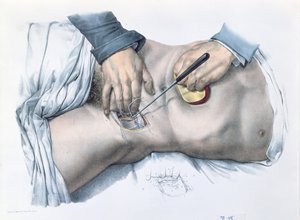जीन-बैप्टिस्ट मार्क बर्गरी (1797-1849) 1866-67 द्वारा &39;आर्ट ऑफ एनाटॉमी ऑफ एनाटॉमी ऑफ मैन&39; से एक धमनी को बांधना द्वारा निकोलस हेनरी जैकब