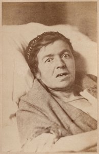 हिस्टेरिकल मिर्गी, संकुचन का चेहरा, बॉर्नविले और पी। रेग्नार्ड, पेरिस, 1876 (एल्बम प्रिंट) द्वारा &39;ला सालपेट्रीयर की फोटोग्राफिक आइकनोग्राफी&39; से प्लेट VIII द्वारा पॉल रिगार्ड