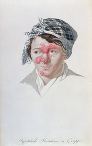 सिओफिलिक क्लस्टर पुस्टुल्स, बैरन जीन लुइस एलिबर्ट (1768-1837) 1838 की एक पुस्तक से