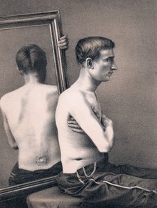 पेट में एक गोली के घाव की आकस्मिक वसूली, अमेरिकी गृहयुद्ध, 1865 द्वारा अज्ञात