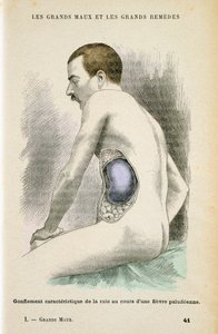 मलेरिया रोगी की विशिष्ट बढ़ी हुई तिल्ली, c1890 द्वारा अज्ञात