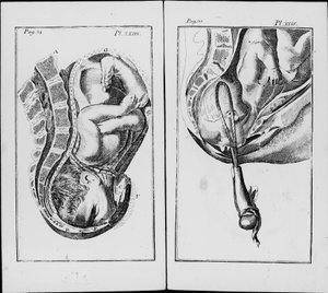 विलियम स्मेली (1697-1763) द्वारा "मिडवाइफरी के अभ्यास का एक संक्षिप्त विवरण" से संदंश प्लेट के उपयोग के साथ एक बच्चे का जन्म द्वारा अज्ञात कलाकार