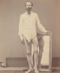 लेफ्ट फीमर के मिडिल थर्ड का गनशॉट वाउंड, 1865-67।