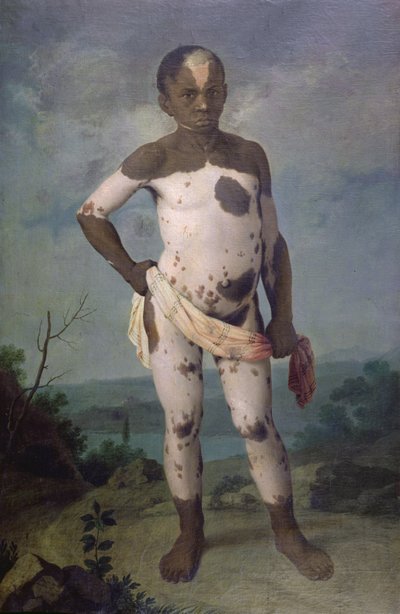 विटिलिगो के साथ बच्चे, 1786 द्वारा ब्राजील के स्कूल