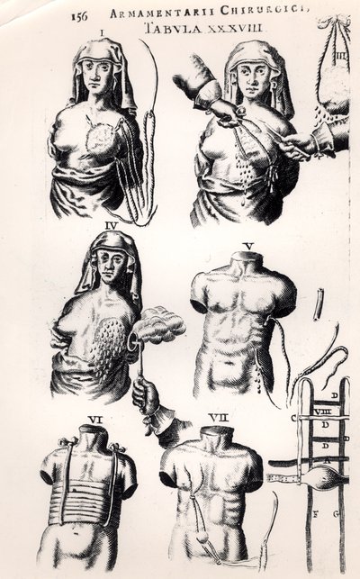 स्तन कैंसर पर संचालन, जोहानस शुल्टेस (1595-1645) द्वारा आर्मामेंटरी चिरुर्गिकी से, एम्स्टर्डम में 1672 में प्रकाशित द्वारा डच स्कूल
