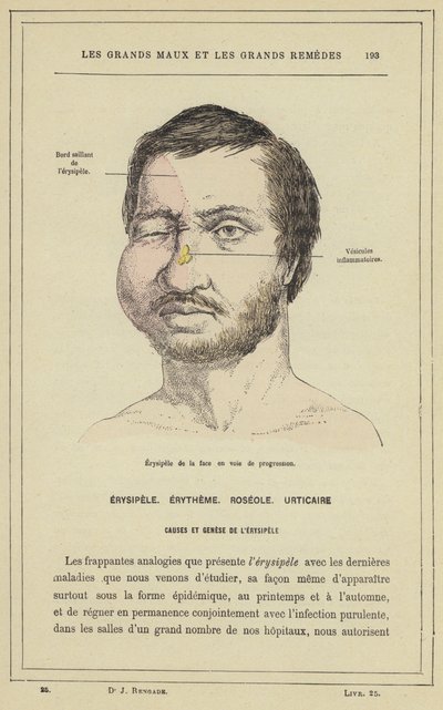 प्रोग्रेसिव फेशियल एरिज़िपेलस (कलर लिथो) द्वारा फ्रेंच स्कूल