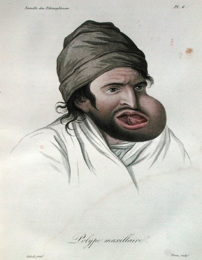 मैक्सिलरी पॉलीप, बैरन जीन लुइस एलिबर्ट (1768-1837) 1817 (रंगीन उत्कीर्णन) की एक पुस्तक से द्वारा फ्रेंच स्कूल