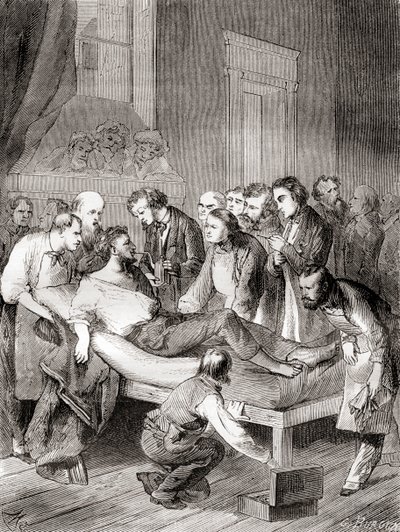 1846 में एक अमेरिकी दंत चिकित्सक, विलियम थॉमस ग्रीन मॉर्टन द्वारा शल्य संवेदनाहारी के रूप में साँस के ईथर के उपयोग का पहला सार्वजनिक प्रदर्शन, 'लेस मर्वेल्स डे ला साइंस' से प्रकाशित, c.1870 द्वारा फ्रेंच स्कूल