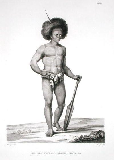 पापुआ द्वीप समूह: लेप्रोसी विक्टिम, 'वॉयेज ऑटोर डू मोंडे (1817-20)' से, लुई क्लाउड डेसौल्स डी फ़्रीसिनेट (1779-1842) द्वारा उत्कीर्ण, फॉरगेट द्वारा उकेरा गया, 1822-24 (लिथो) में प्रकाशित हुआ। द्वारा जैक्स एटियेन विक्टर (बाद में) अरागो