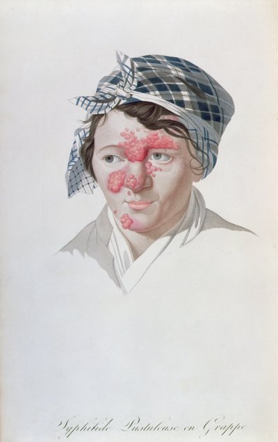सिओफिलिक क्लस्टर पुस्टुल्स, बैरन जीन लुइस एलिबर्ट (1768-1837) 1838 की एक पुस्तक से द्वारा साल्वाडोर ट्रेस्का