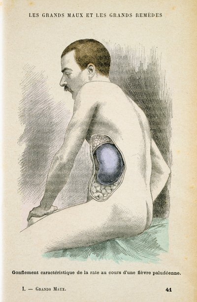 मलेरिया रोगी की विशिष्ट बढ़ी हुई तिल्ली, c1890 द्वारा अज्ञात