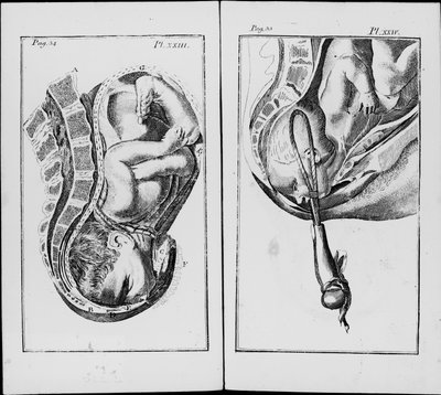 विलियम स्मेली (1697-1763) द्वारा "मिडवाइफरी के अभ्यास का एक संक्षिप्त विवरण" से संदंश प्लेट के उपयोग के साथ एक बच्चे का जन्म द्वारा अज्ञात कलाकार