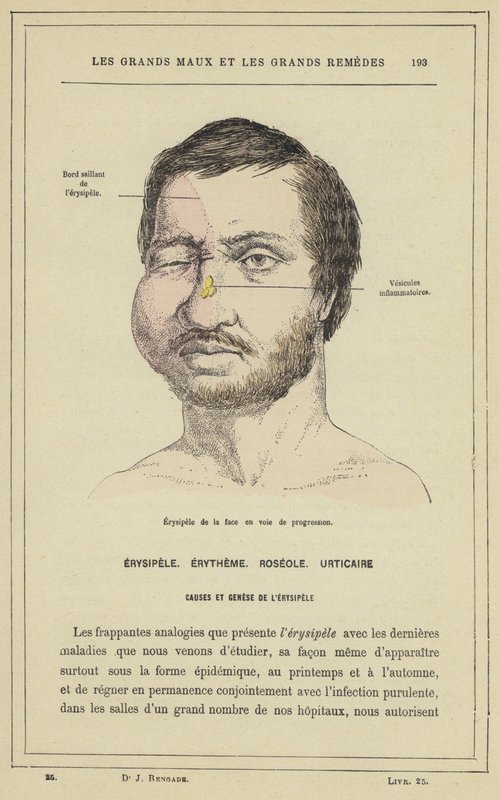 प्रोग्रेसिव फेशियल एरिज़िपेलस (कलर लिथो) द्वारा फ्रेंच स्कूल