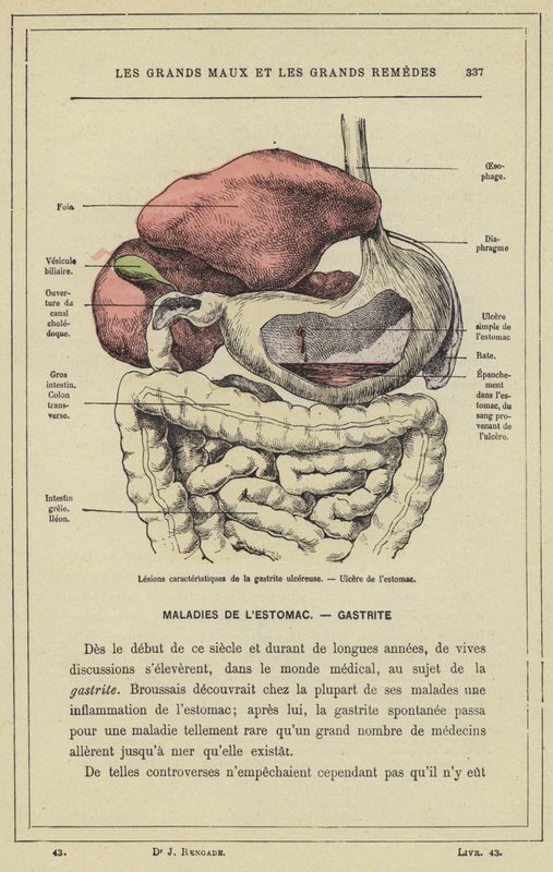 अल्सरेटिव जठरशोथ, पेट के अल्सर (रंग लिथो) के विशिष्ट घाव द्वारा फ्रेंच स्कूल