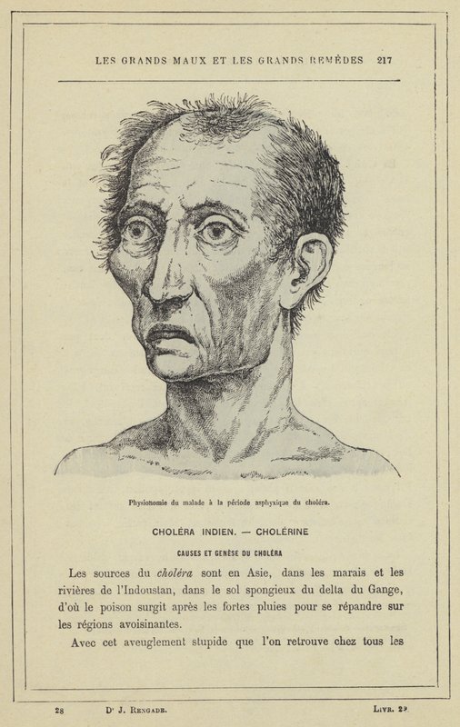 हैजा (रंग लिथो) की श्वासावरोध अवधि के दौरान रोगी की शारीरिक पहचान द्वारा फ्रेंच स्कूल